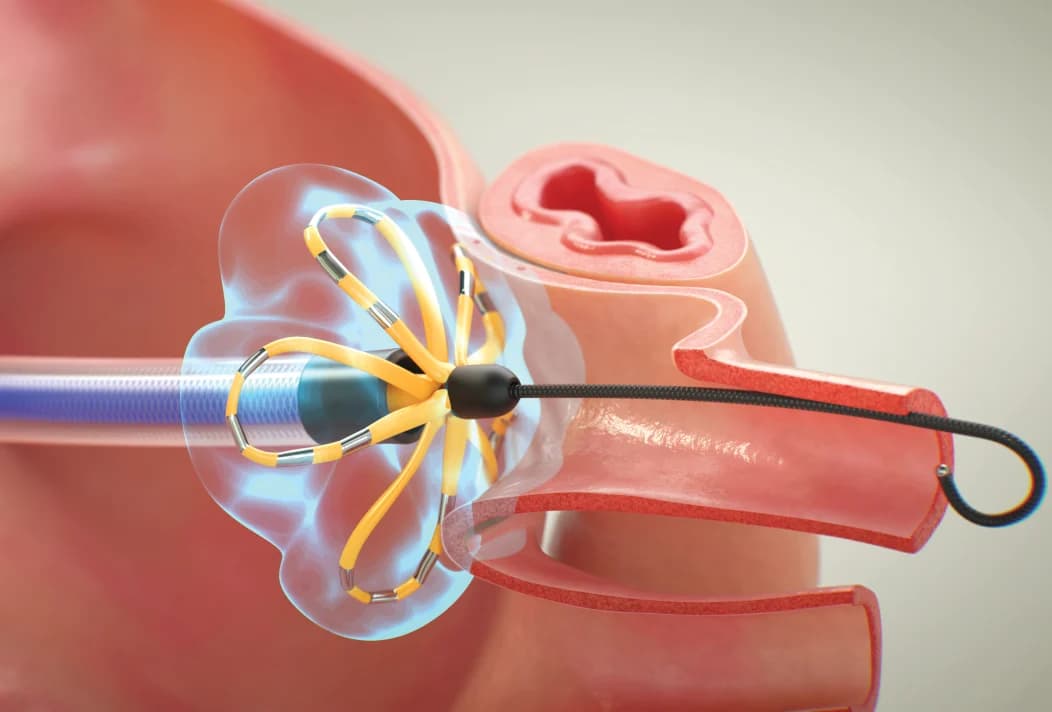 Intervention and Ablation